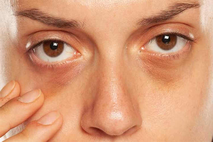 How to get rid of dark circles under the eyes