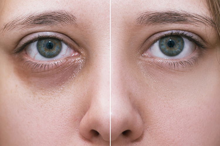 How to get rid of dark circles under the eyes