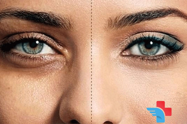 How to get rid of dark circles under the eyes